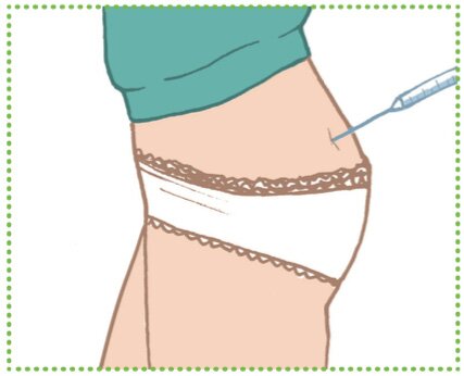 prothese-piqure-fesses